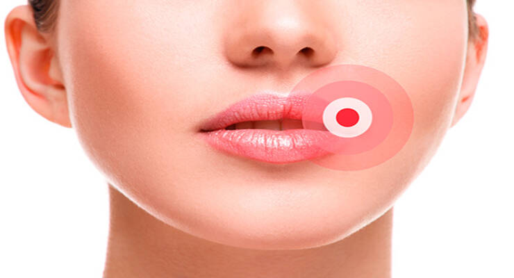 Фото к статье: Простуда на губах: причина, лечение и профилактика