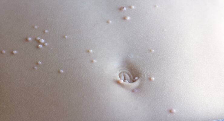 Фото к статье: Контагиозный моллюск у ребенка: симптомы и лечение