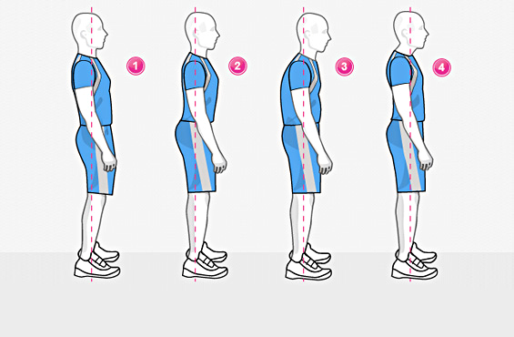 Нарушение осанки, виды, причины, профилактика нарушения